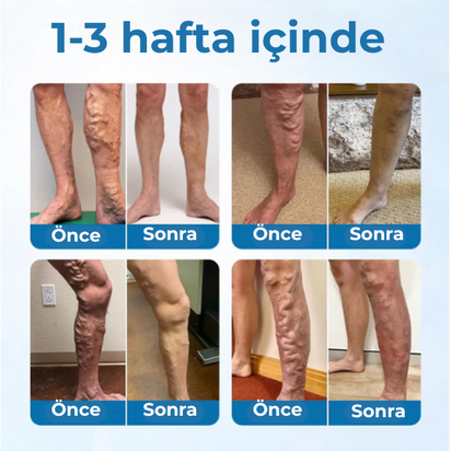 Timilk® VeinGuard Bitkisel Sprey – ✅ Klinik olarak kanıtlanmış etkisiyle sadece 7 günde varis görünümünü azaltır!